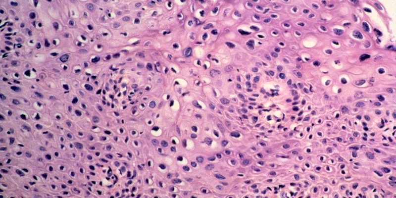 An image of mild abnormal development of cervical cells